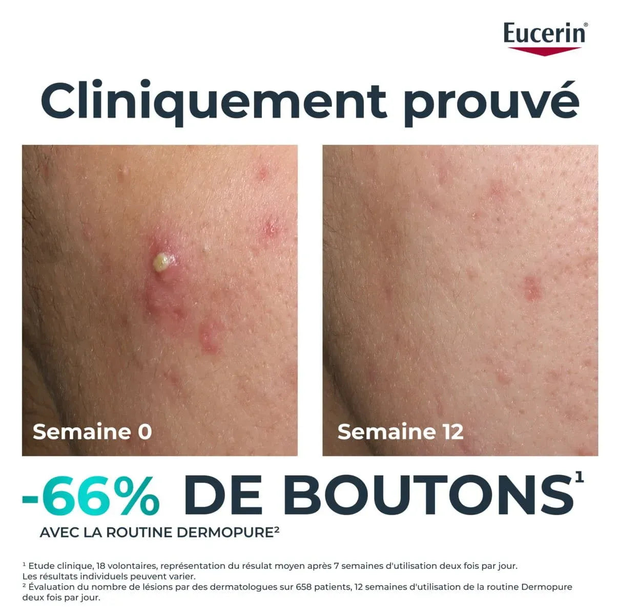 Eucerin DermoPure Clinical Sérum Triple Action 50ml
